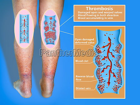 Dyb Venetrombose Eller Blodpropper. Embolus. - Stockphoto #27100862 ...